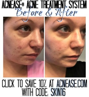  photo Acnease Ad_zps1zx5d5hn.jpg